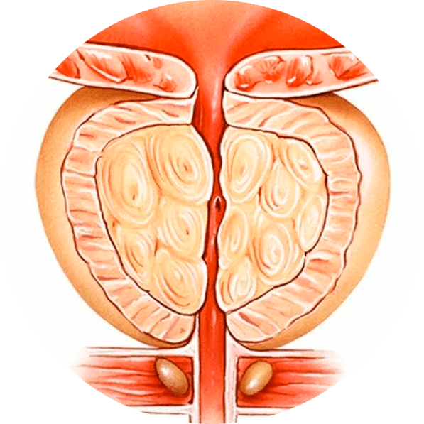 Consequences of untreated prostatitis