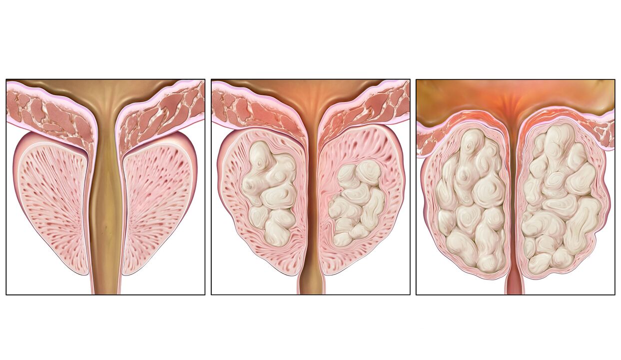 Stages of prostate cancer
