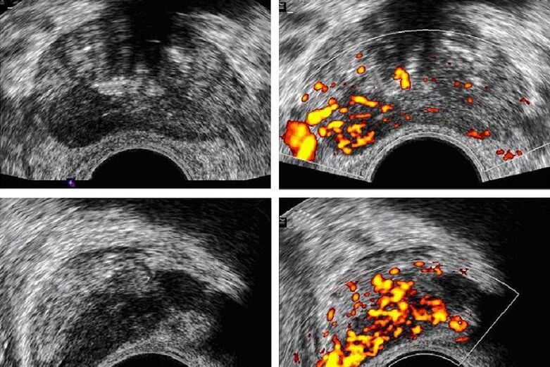 diagnose prostate cancer