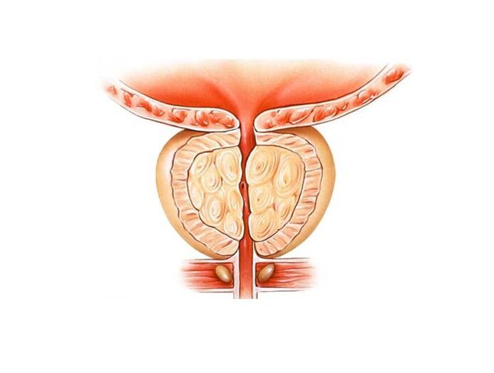 Treat prostatitis with folk remedies