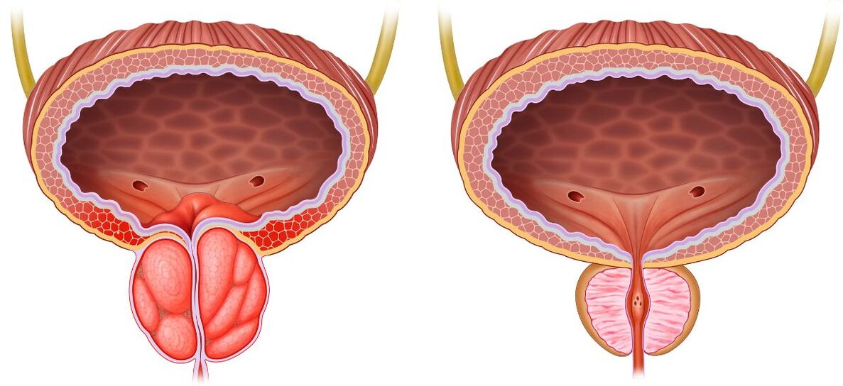 healthy and diseased prostate