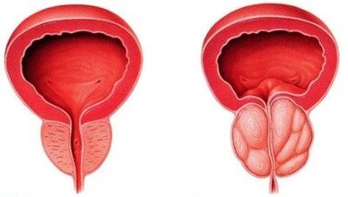 the prostate is healthy and inflamed with prostatitis